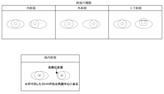 斜視の種類